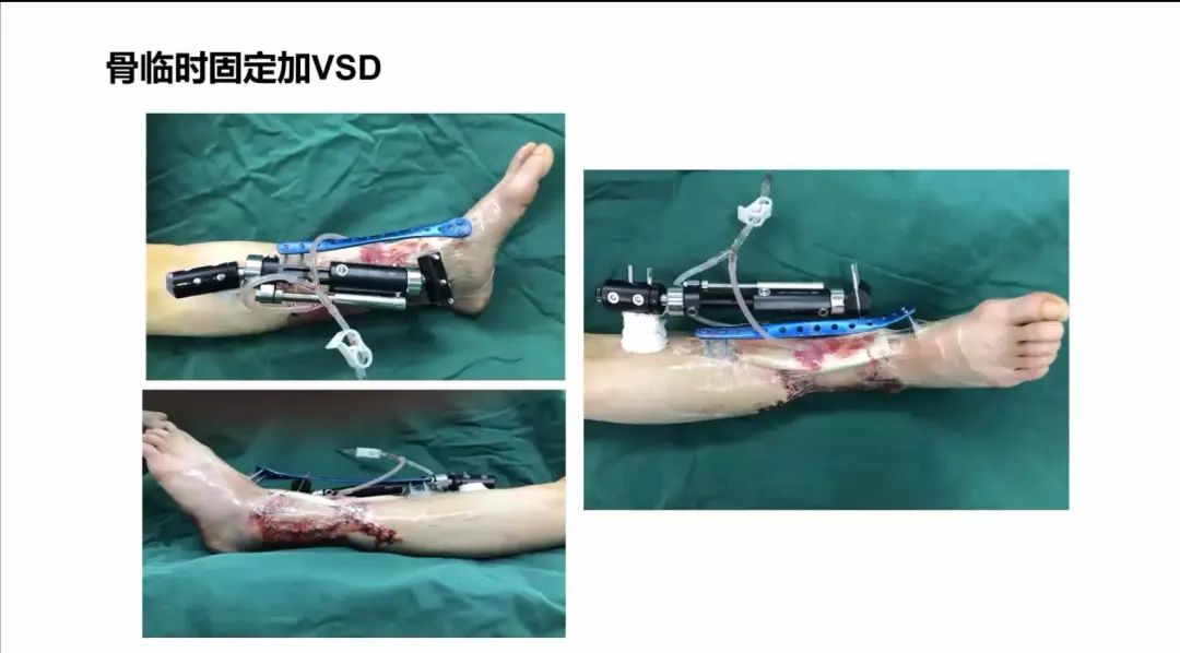 聚焦顯微外科|葫蘆島市醫(yī)學會顯微外科學分會第一屆第二次學術(shù)會議順利召開(圖22) 聚焦顯微外科|葫蘆島市醫(yī)學會顯微外科學分會第一屆第二次學術(shù)會議順利召開(圖22)